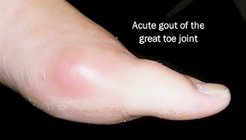 Gout | Causes and treatment options Myfootshop.com