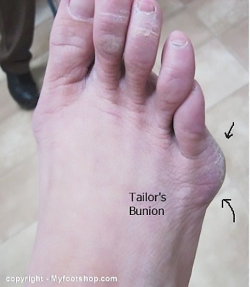 Bunion Little Toe