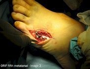 Metatarsal_fracture_surgery_image3