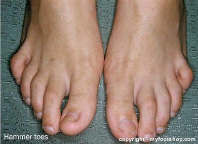 Hammer Toe Pads - What's the right pad to treat claw toes?