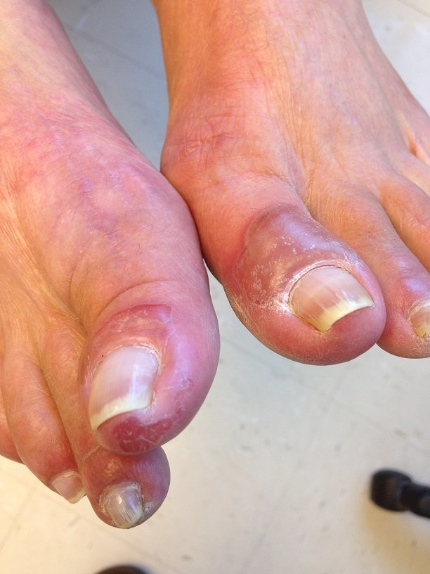 Pemphigus vulgaris of the foot | MyFootShop.com