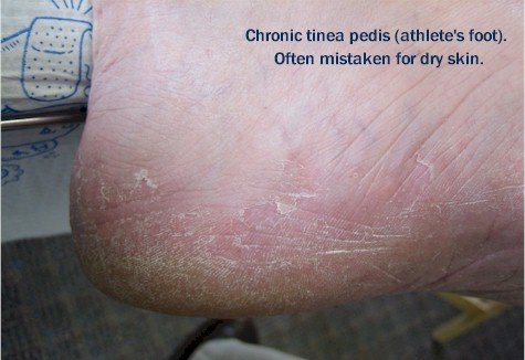 cracked feet fungus