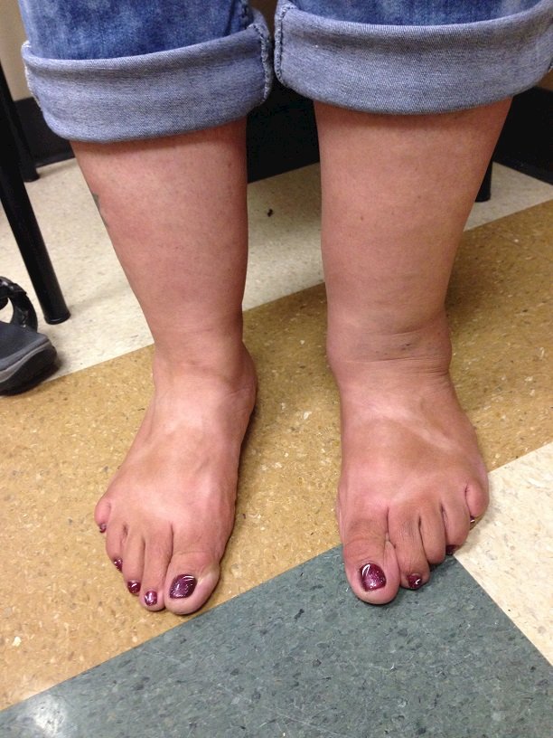 viking feet syndrome
