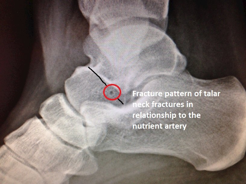 talus bone fracture