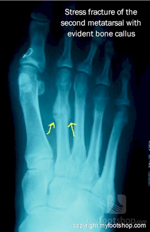 Stress fracture