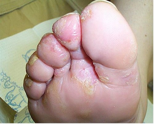 Athlete's Foot, Causes and treatment options