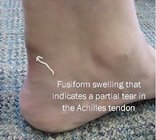 Achilles Tendon Ruptures | Causes and treatment options | | MyFootShop.com