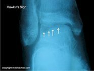 Talar Dome Fractures | Causes and treatment options | MyFootShop.com