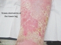 Dermatitis | Causes and treatment options | MyFootShop.com