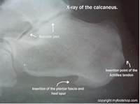 Heel Spur | Causes and treatment options | MyFootShop.com