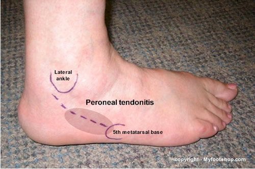 Peroneal Tendonitis | Causes and 