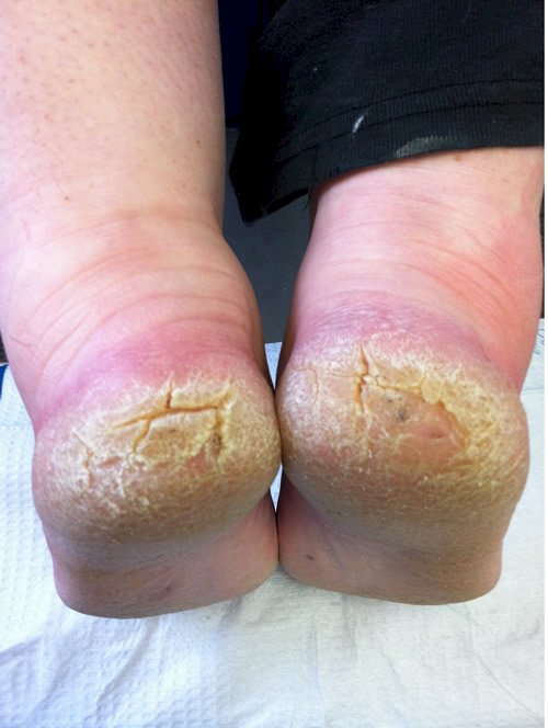 Dr. Foot Cracked Heel Cream. Rough Spot Cream for India | Ubuy