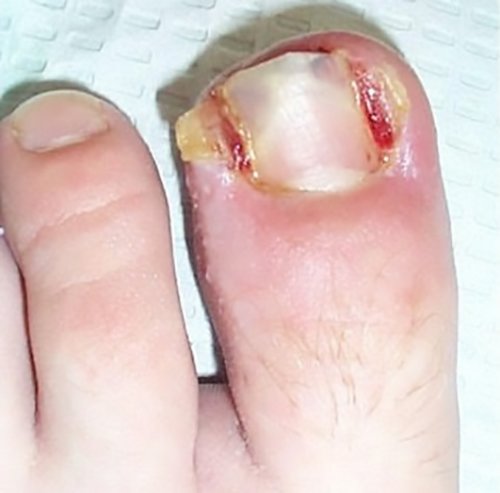Tropical Climate Causing Fungal Nail | Lower Limb Specialist Centre