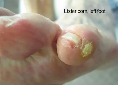 corn on pinky toe painful