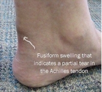 Achilles Tendon Ruptures | Causes And Treatment Options | | MyFootShop.com