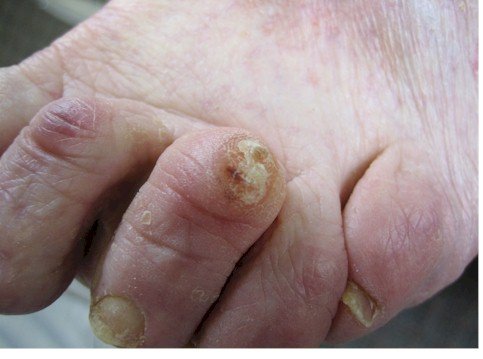 callus on toe knuckle