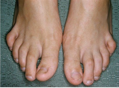 Hammer toes, claw toes, mallet toes treatment: hammer toes pictures before  and after