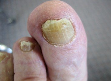 Onychomycosis | Causes and treatment options | MyFootShop.com